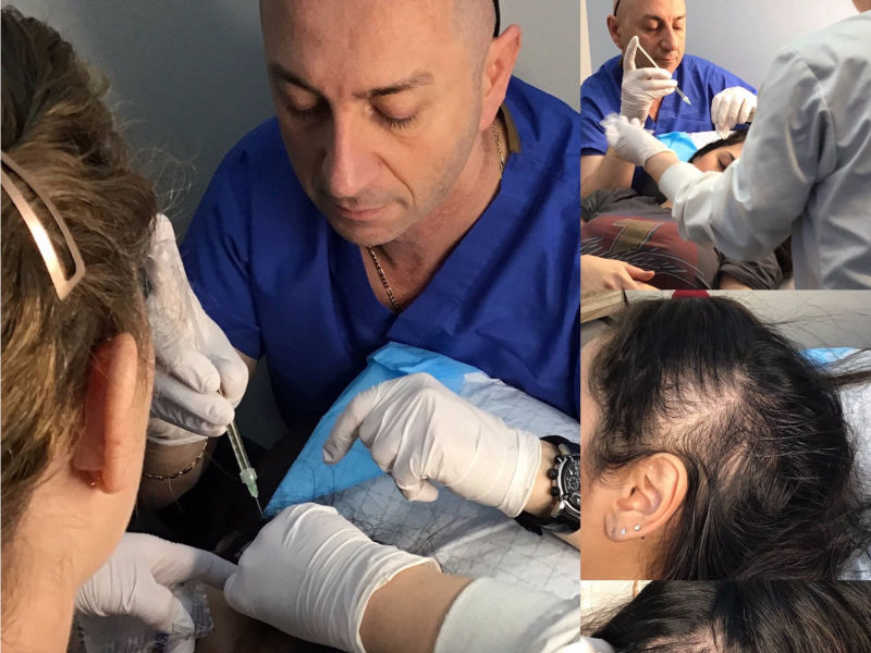 PRP HAIR RESTORATION