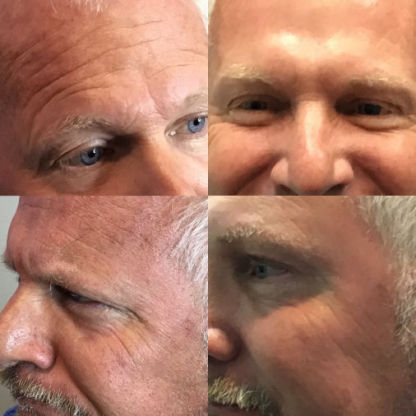 Brotox before and after