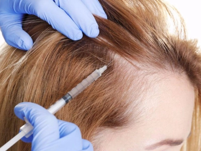 PRP Hair Restoration