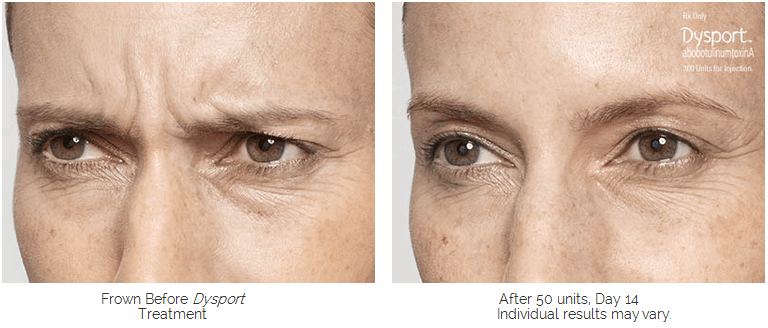 Botox/Dysport/Xeomin