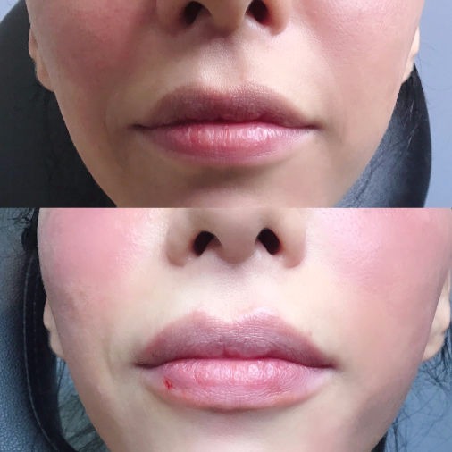 Lips Injection