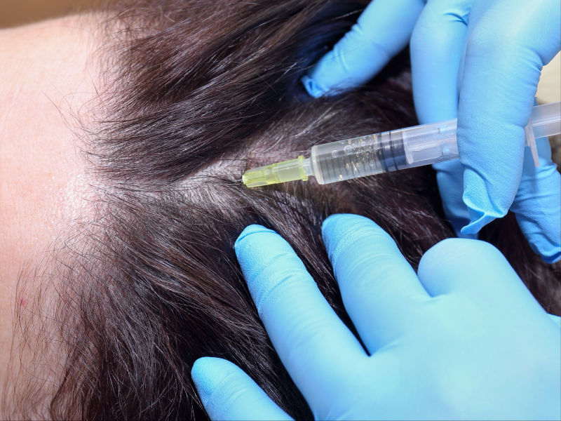 PRP Hair Restoration