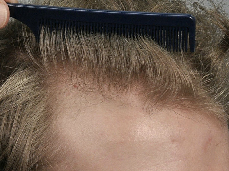 PRP HAIR RESTORATION