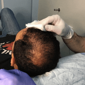 PRP Hair restoration 