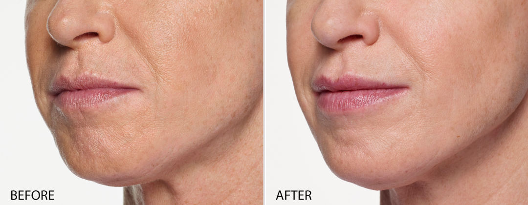 Lip Enhancement, Lip Fillers